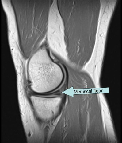 meniscal tear on sagittal MRI of knee