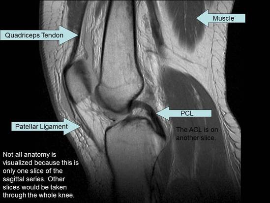 sagittal MRI of knee