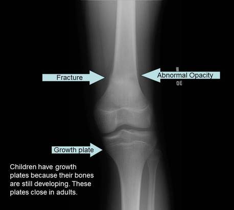 AP Radiograph of knee showing stress fracture