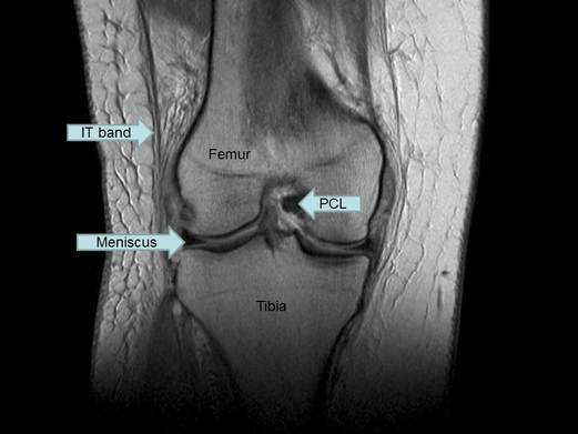 Coronal MRI of knee