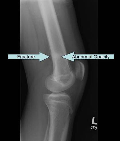 Lateral radiograph of knee showing stress fracture