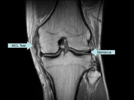 MCL tear on coronal MRI of knee