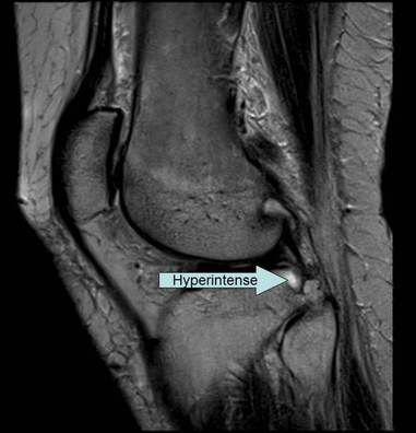 sagittal MRI of knee showing an hyperintense area