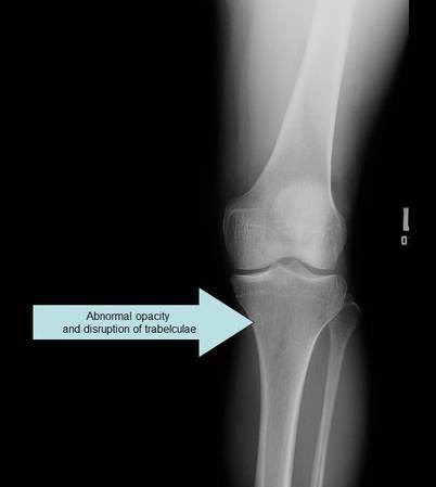 additional stress fracture case