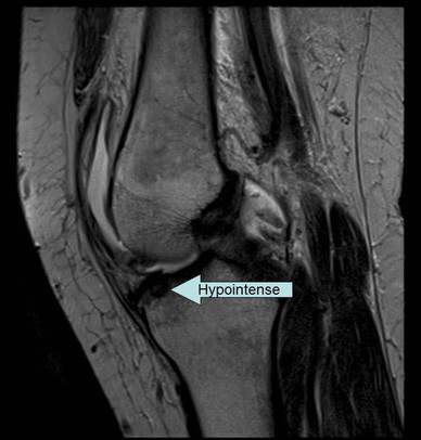 sagittal MRI of knee showing a hypointense area