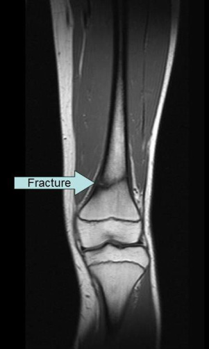 stress fracture on coronal MRI of knee