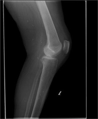 lateral view of knee